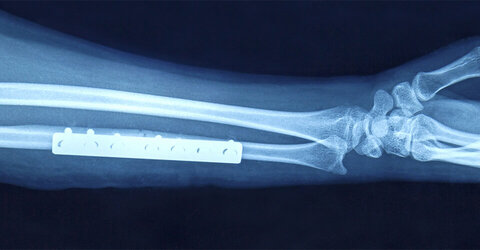 Röntgenbild eines Knochenbruches mit Metallschiene